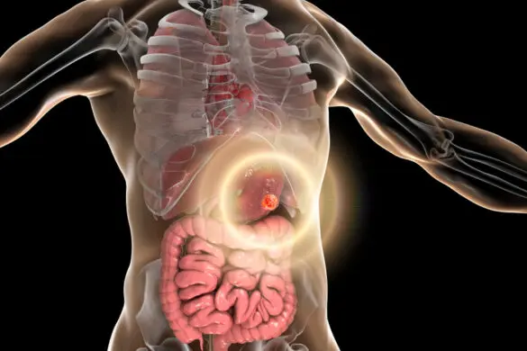 What is a Gastrointestinal Stromal Tumour (GIST)? How Is It Treated?