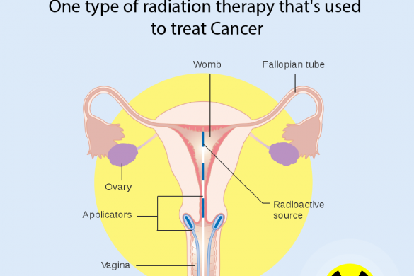 What is Brachytherapy for Cervical Cancer?