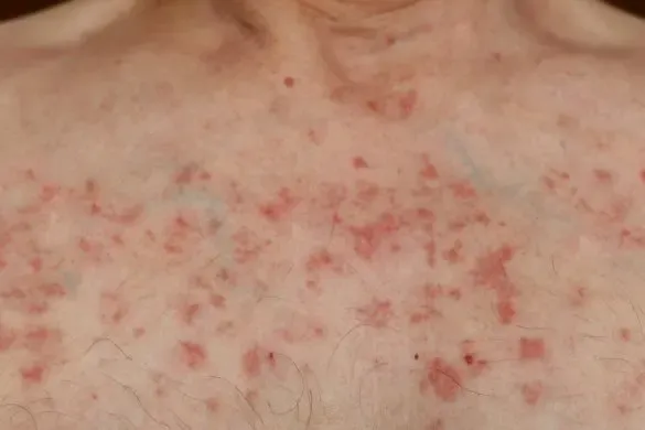 Skin Changes During Chemotherapy – Causes and Management